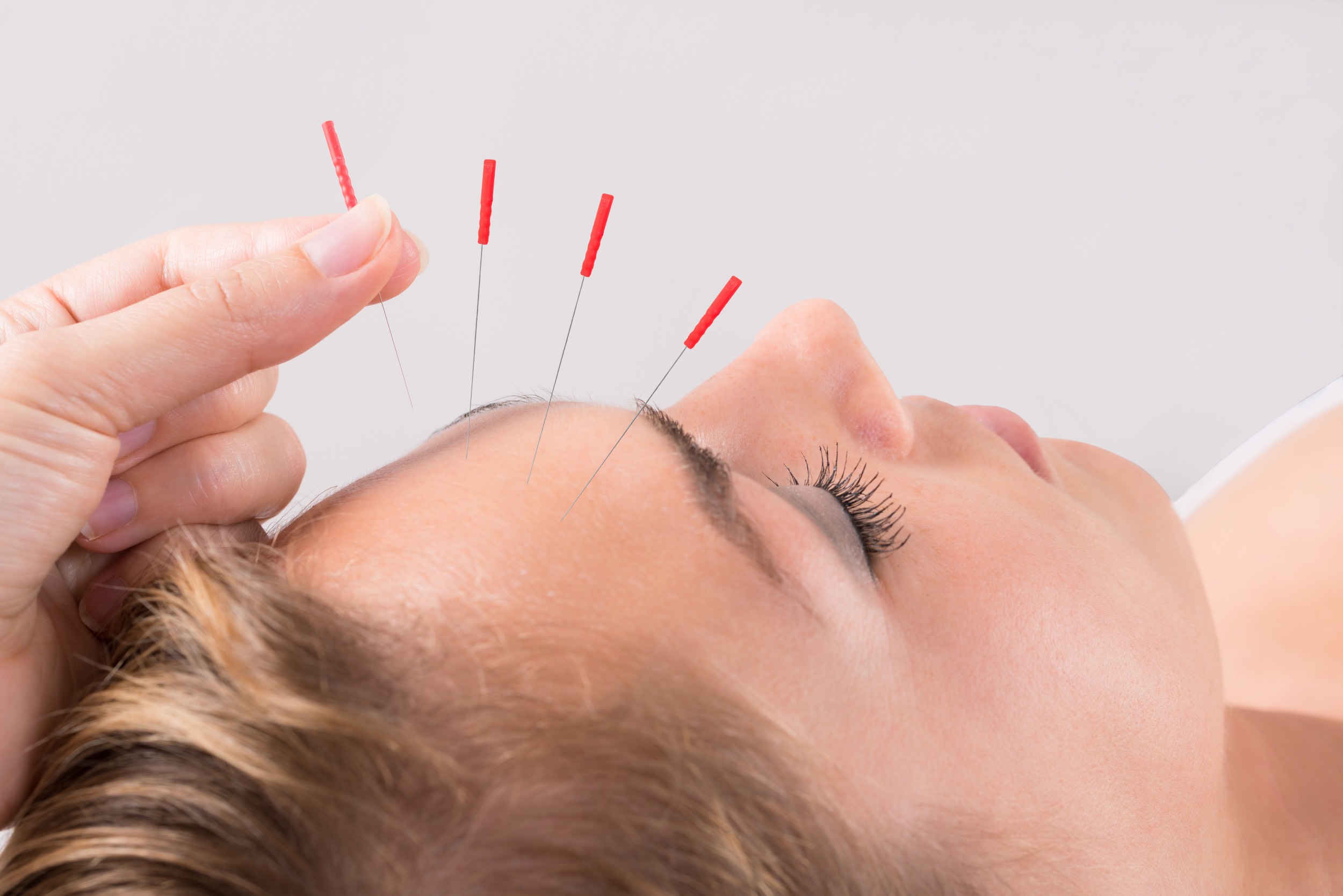 acupunctuur